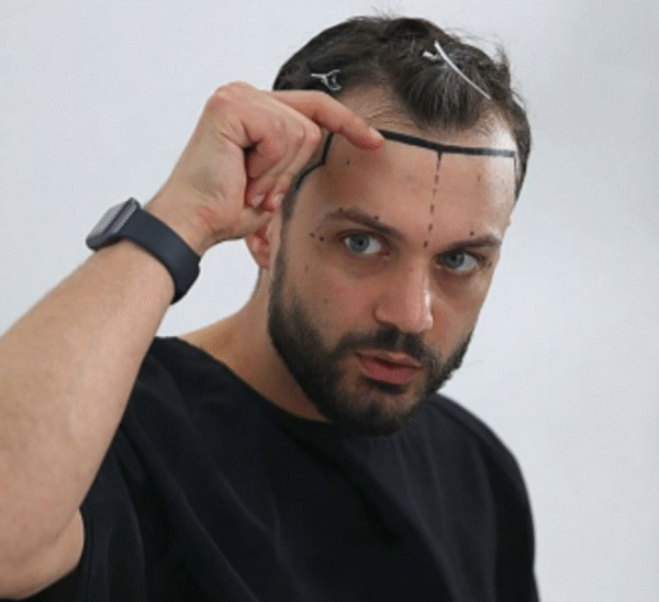 Hair Transplant Results: What to Expect After 6–12 Months